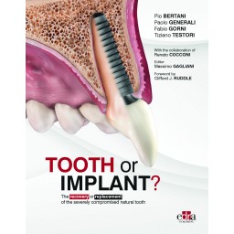 Tooth or Implant. The...