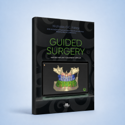 GUIDED SURGERY Making implant placement simpler - implant - SURGERY - Nicholas G.C. Fahey