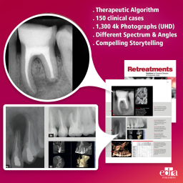 Retreatment. Solutions for apical diseases of endodontic origin - Book Details - Dentistry Book