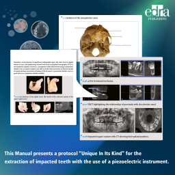 Piezoelectric surgery of impacted teeth - book details - dentistry book - cardarelli